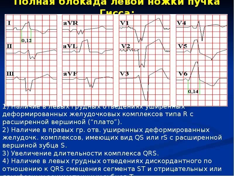 Блокада левого и правого пучка гиса. ЭКГ признаки блокады левой ножки пучка. Блокада левой ножки пучка Гиса на ЭКГ. ЭКГ критерии полной блокады левой ножки пучка Гиса. ЭКГ при блокаде левой ножки пучка Гиса.