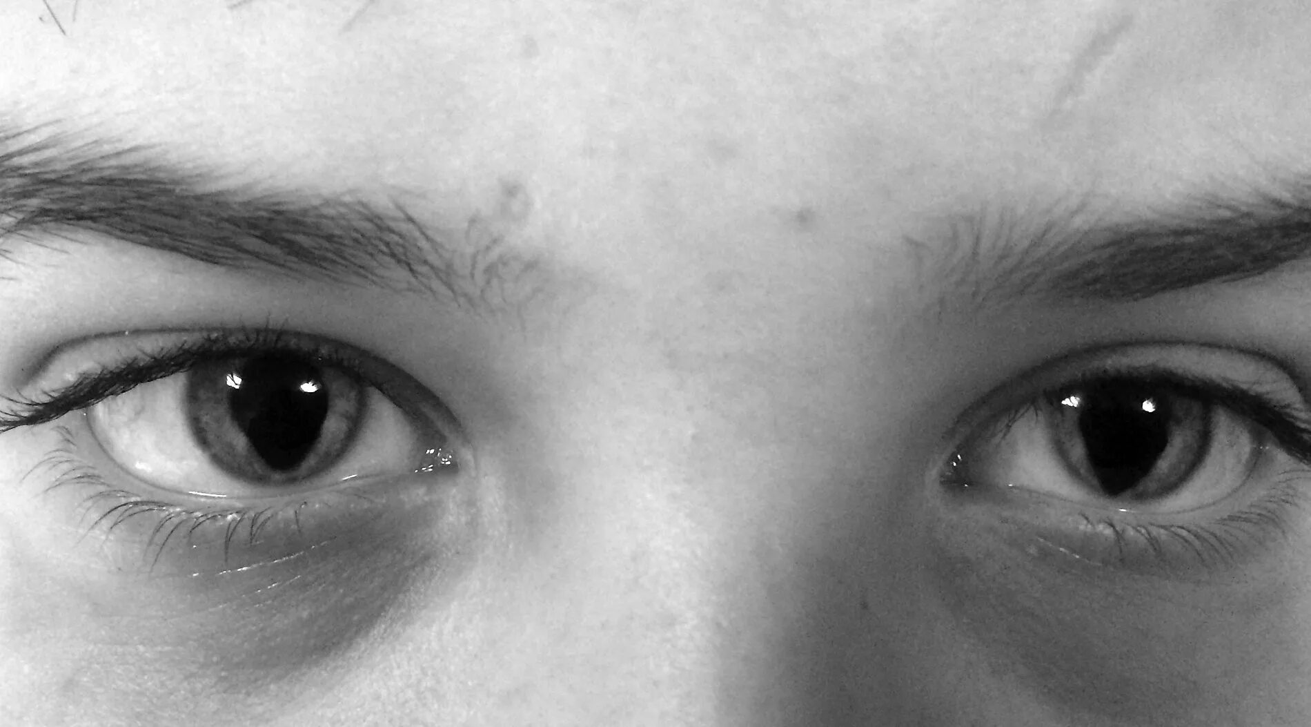 Колобома радужной оболочки. Синдром Шмида-Фраккаро синдром кошачьего глаза. Колобома зрачок кошачий глаз.