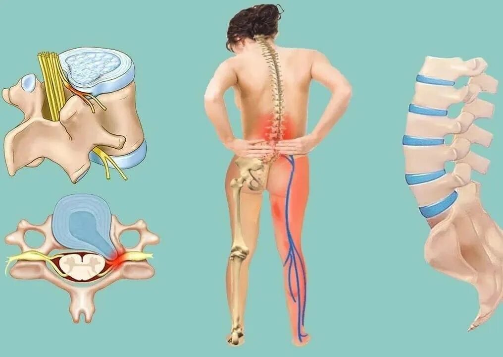 Лечится ли грыжа. Лечится ли грыжа