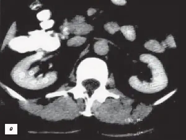 Гипертрофированная колонна Бертини почки что это. Гипертрофированная колонна Бертини на УЗИ. Гипертрофия почечных столбов кт. Горбатая почка