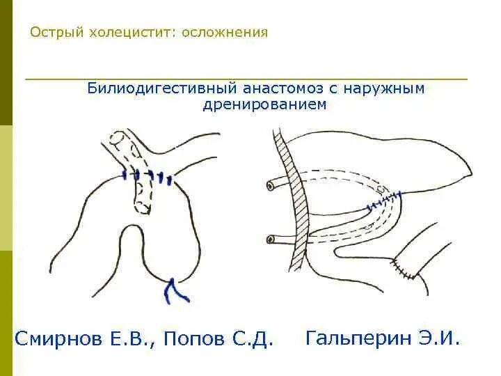 Холецистит дренаж