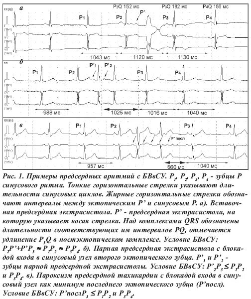 Фибрилляция предсердий холтер. Экг ишемия миокарда с фибрилляция предсердий. Холтер экг трепетание предсердий. Фибрилляция предсердий тахисистолия. Фибрилляция предсердий холтер.