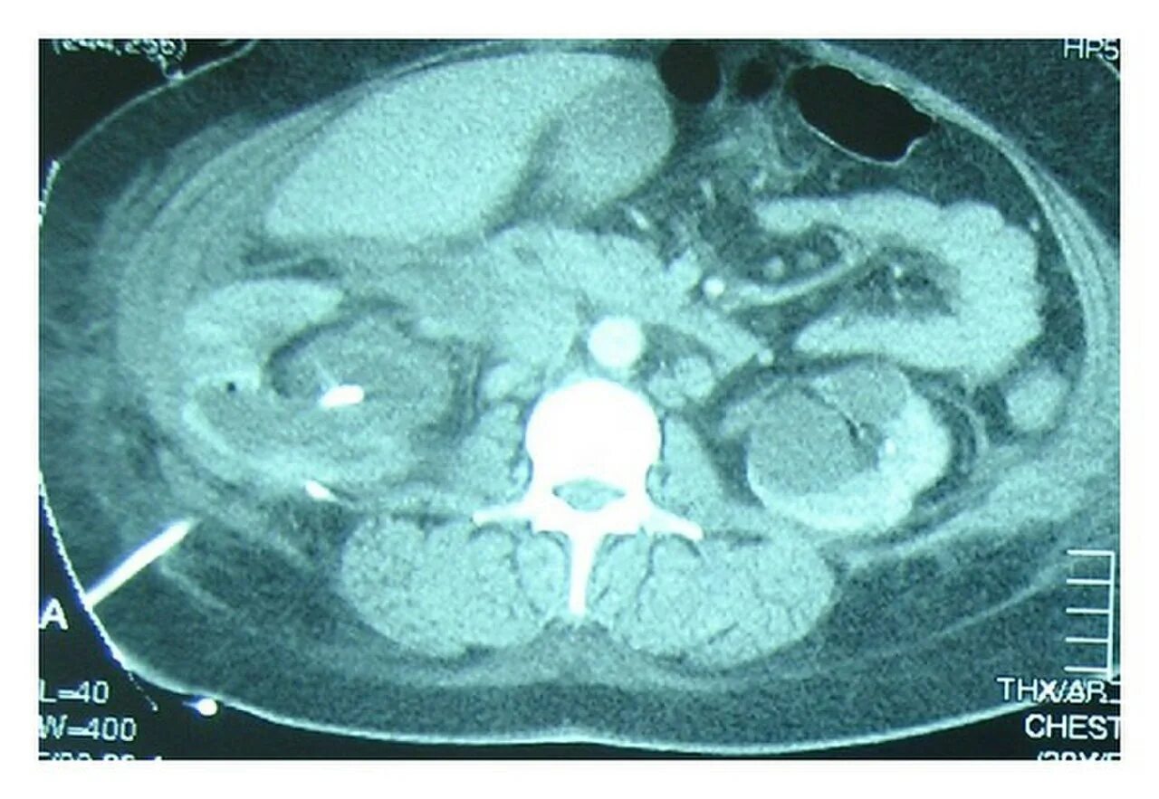 Кт диагностика поражения легких при covid-19. Баллы поражения легких по кт. Кт при пневмонии. Результаты кт легких при коронавирусе. Легкие на кт при коронавирусе.