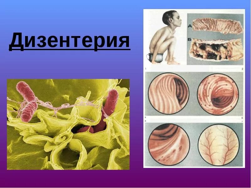 Дизентерия проявления. Дизентерия шигеллез. дизентерии (shigella dysenteriae). дизентерия вызывается шигеллами.