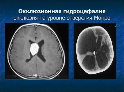 Окклюзионная гидроцефалия