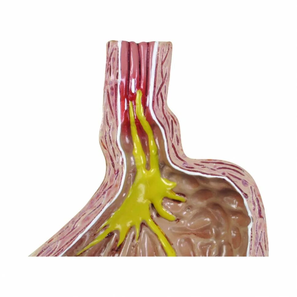 Гастроэзофагеальный рефлюкс мкб 10 у детей. Гастроэзофагеальный рефлюкс симптомы. Гастро-эзофагальный рефлюкс симптомы. Гастроэзофогальнаярефлюкснаяболезнь. Гастроэзофагеальный рефлюкс классификация.