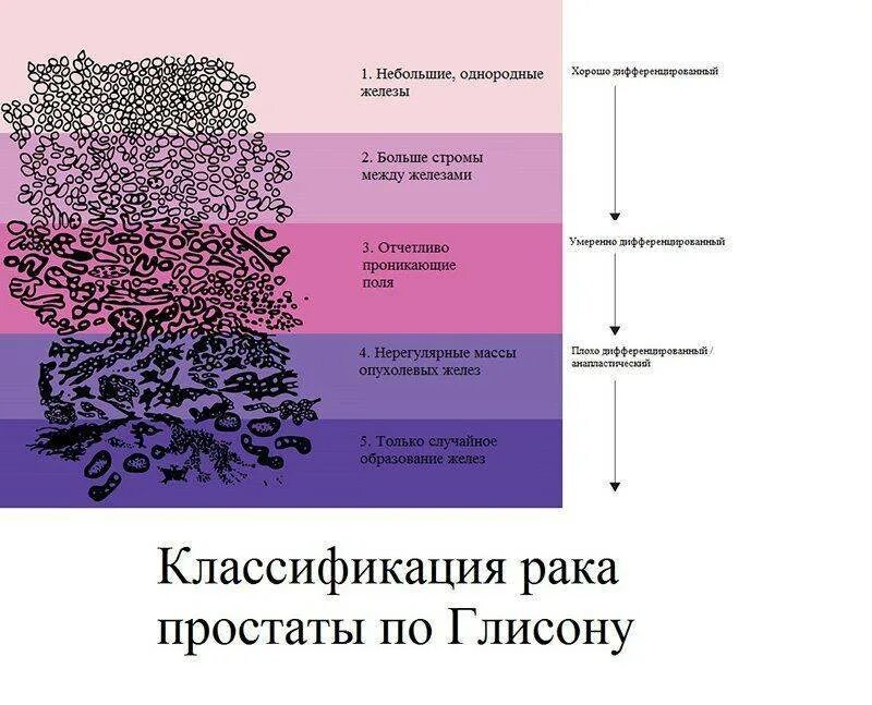 2 стадия 2 стадия рака предстательной. 2 стадия 2 стадия рака предстательной