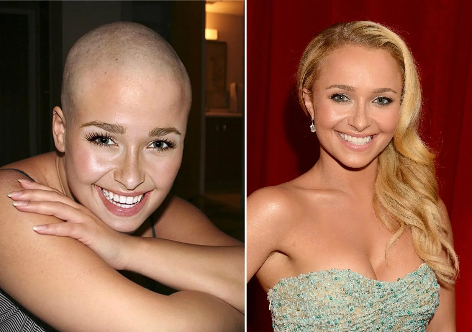 Рост волос после химиотерапии. Лысые девушки. Лысые женщины до и после. Лысые звезды женщины.