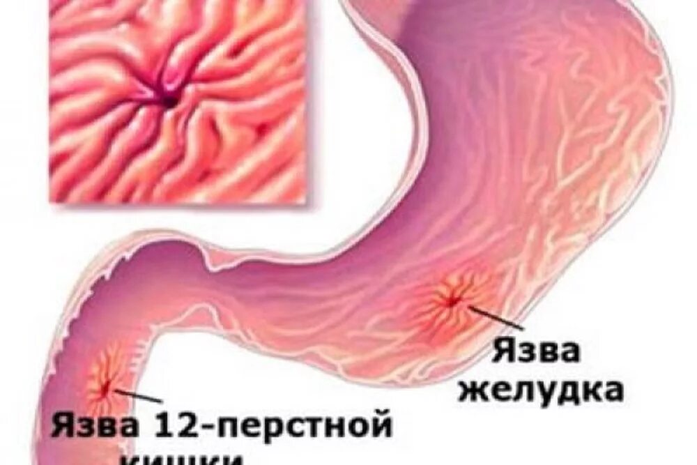 Болезни двенадцатиперстной кишки у ребенка. Язва 12 перстной кишки слайды. Язва желудка и 12 перстной кишки. Язвенная болезнь 12 перстной кишки.