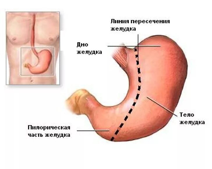 Резекция пилорической части желудка. Антральный отдел желудка. Объем резекции желудка. Операция удаления опухоли желудка