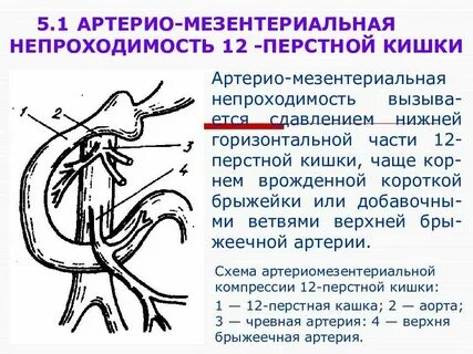 Аорто мезентериальная