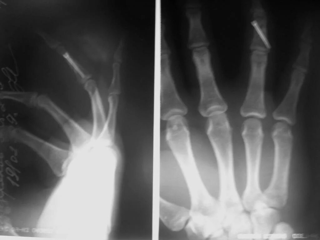 посттравматический артроз рентген. закрытый перелом основной фаланги 1 пальца мкб. краевой перелом ногтевой фаланги. перелом ногтевой фаланги мкб 10. гломусная опухоль фаланги рентген.