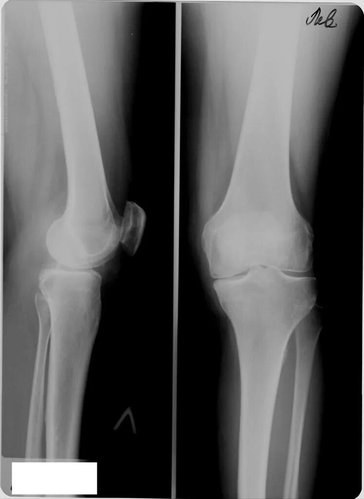 Рентген колена перелом надколенника. Смещение надколенника рентген. Вывих коленного сустава рентген. Перелом чашечки коленного сустава рентген.