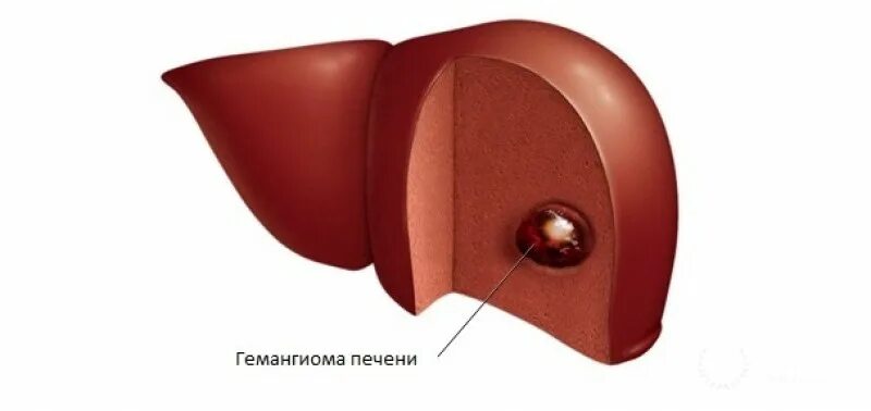 Гемангиома печени что такое и как. Кавернозная гемангиома печени. инфантильная гемангиома печени.