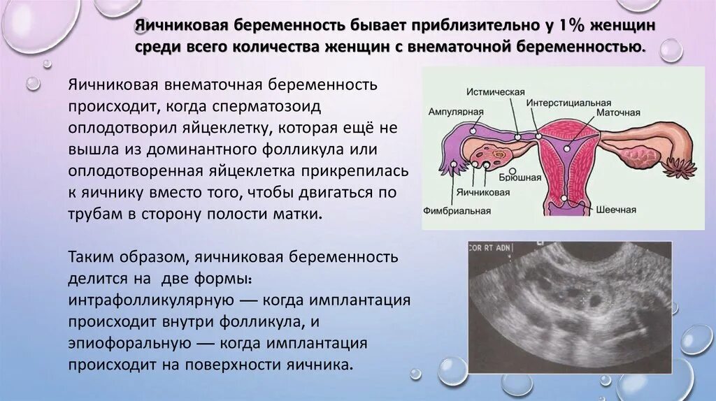 Почему происходит внематочная. Внематочная беременность. Внематочная беременнос. Внематочная беременность симптомы. Фимбриальная Трубная беременность.