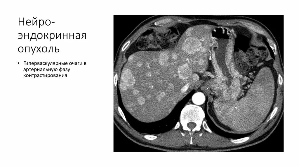 Гиперваскулярное образование печени. Гиповаскулярные метастазы печени кт. Гиперваскулярные метастазы печени кт. Гиповаскулярное образование в печени мрт. Гиповаскулярный очаг в печени что это.