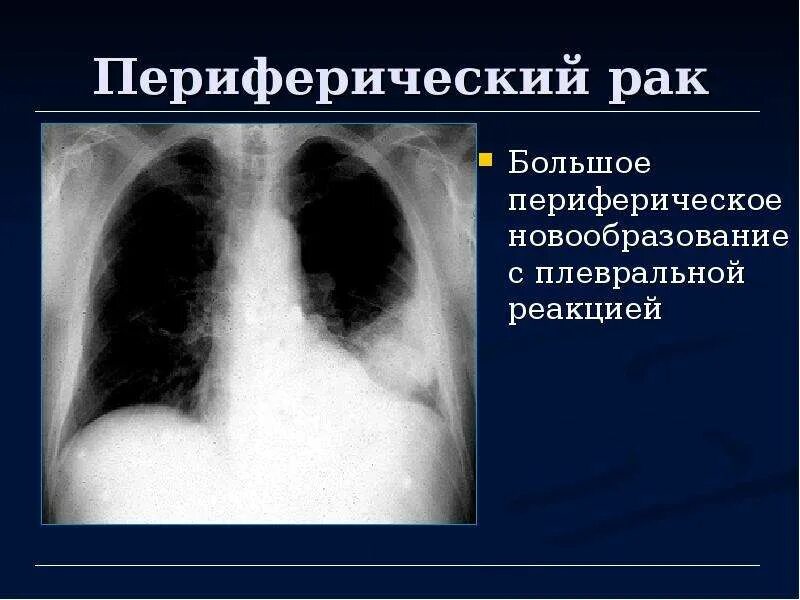 Периферический рак что это. Периферическая карцинома легких кт. Периферический рак что это. Полостное образование. Периферический рак что это.