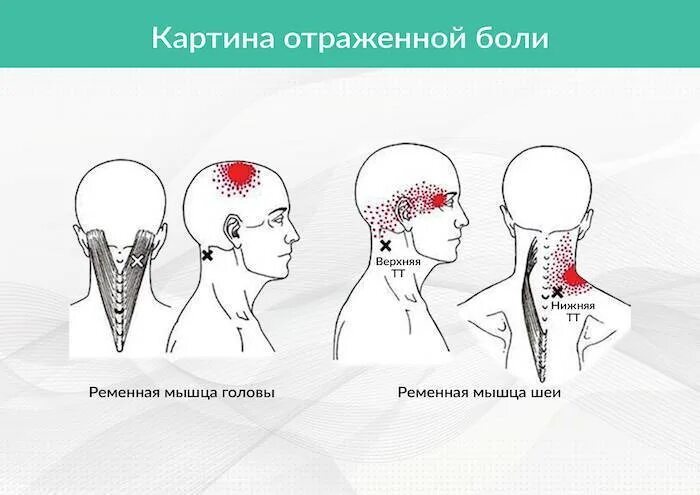 Болит голова и мышцы шеи. Ременная мышца шеи триггерные точки. Ременная мышца головы триггерные точки. Триггерные точки ременных мышц головы и шеи. Ременная мышца головы болит.