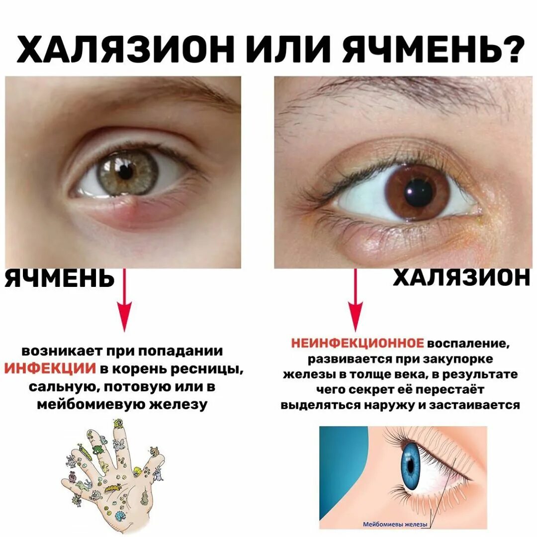 Народное лечение ячменя. Этапы развития ячменя на глазу.