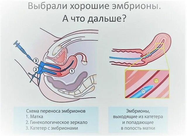 Почему подсаживают. Эмбрион в полости матки после переноса. Перенос эмбриона в матку эко. Перенос эмбрионов в полость матки. Эмбрион в матке после переноса.