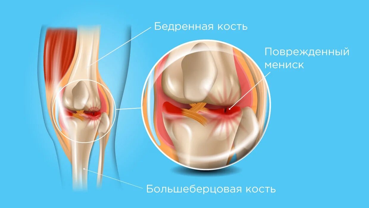 Разрыв мениска коленного сустава. Поврежденный мениск коленного сустава. Хрящ коленного сустава и мениск.
