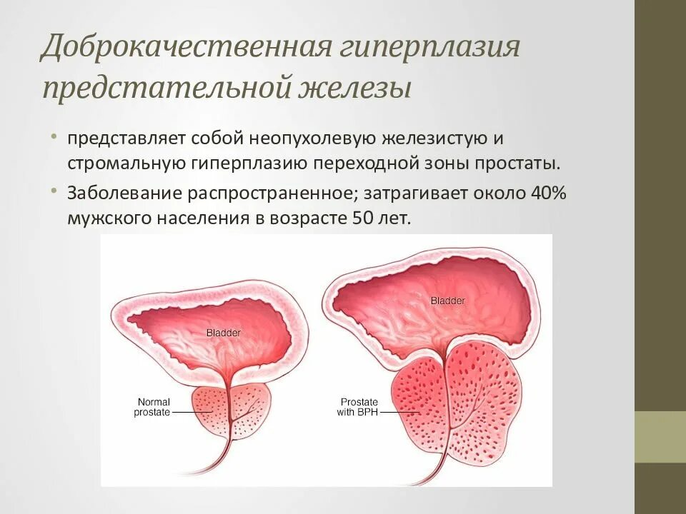 Доброкачественная гиперплазия предстательной железы (ДГПЖ). Стромальная гиперплазия предстательной железы. Доброкачественная гипертрофия предстательной железы степень. Атипическая гиперплазия предстательной железы.