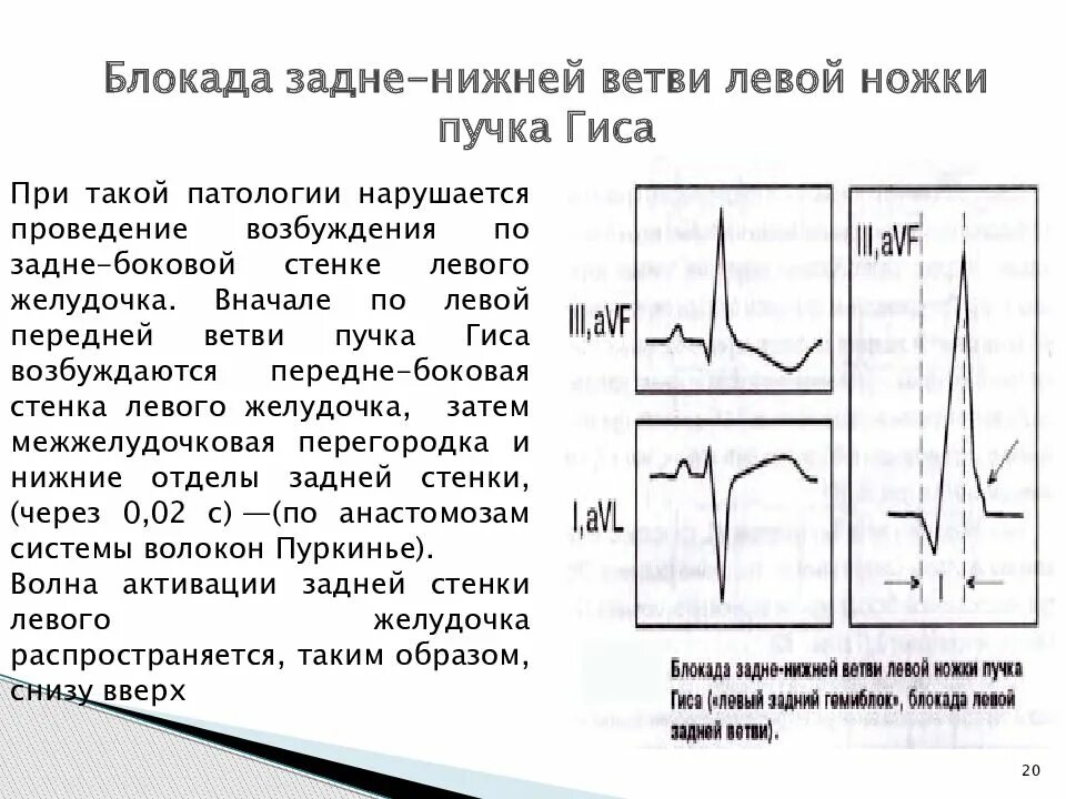 Левая ножка п гиса. Блокада левой ножки пучка Гиса на ЭКГ. Неполная блокада левой ножки пучка Гиса на ЭКГ. Неполная блокада правой и левой ножки пучка Гиса на ЭКГ. Блокада передней ветви ЛНПГ на ЭКГ.