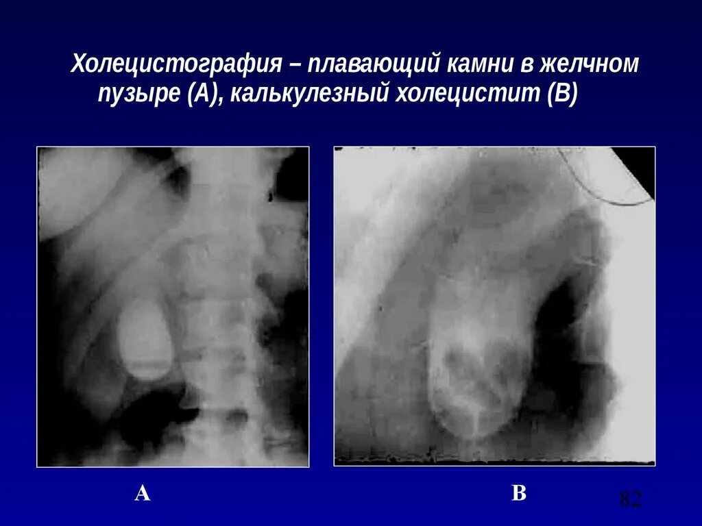 Пероральная холецистография. Конкременты в желчном пузыре рентгенограмма. Холецистография желчнокаменная болезнь. Камни в желчном пузыре при холецистографии. Рентгенологическая холецистография.