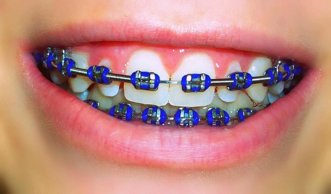 Brackets photo
