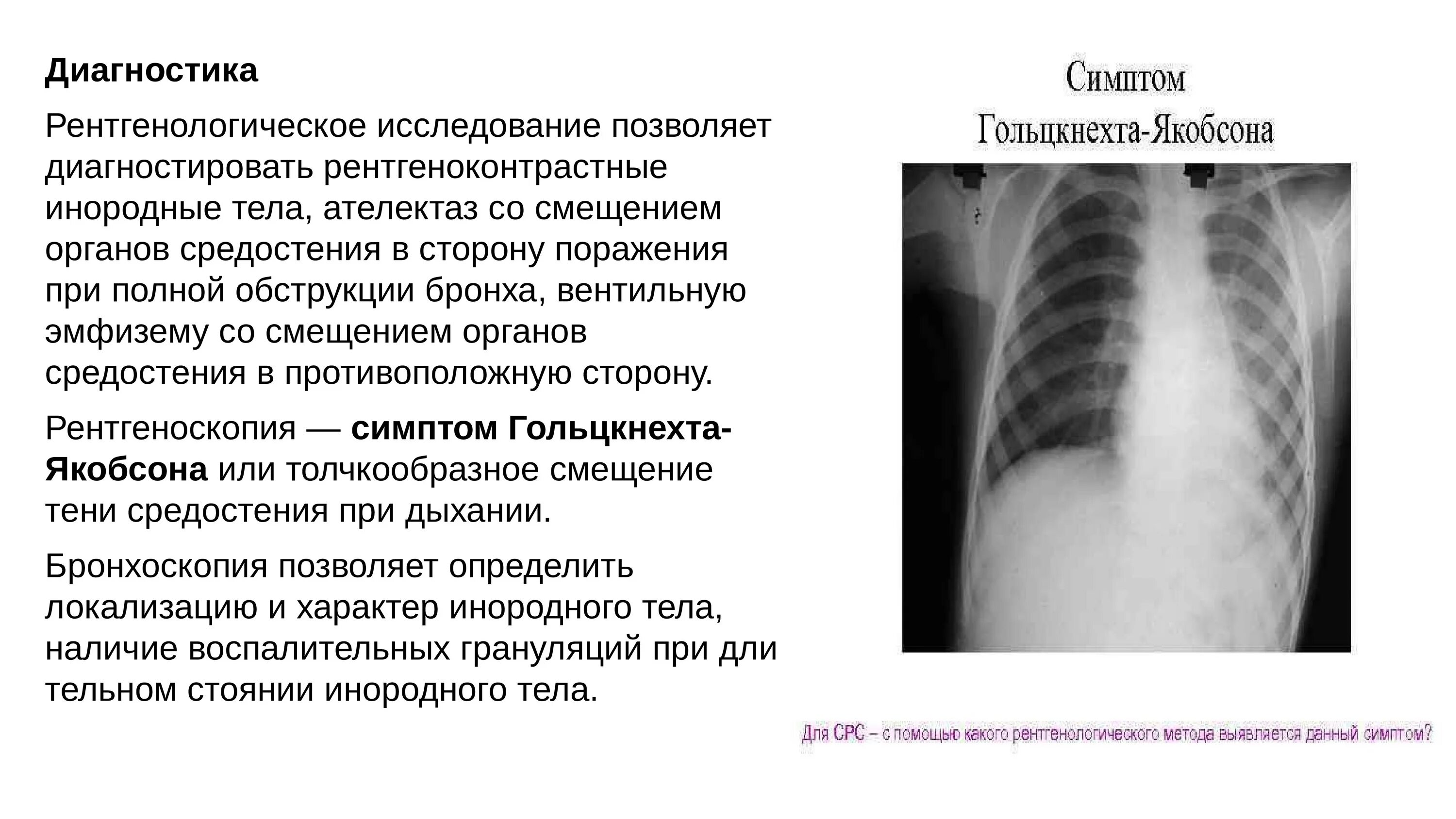 Инородные Тела Трахеи Бронхов