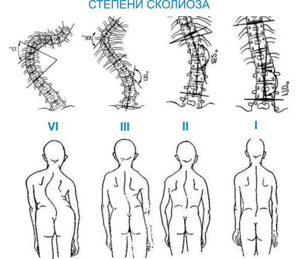 Рентген спины сколиоз 1 степени. Сколиоз 3 степени угол Кобба. Сколиоз 3 степени 50 градусов. Инвалидность сколиоз 2 степени.