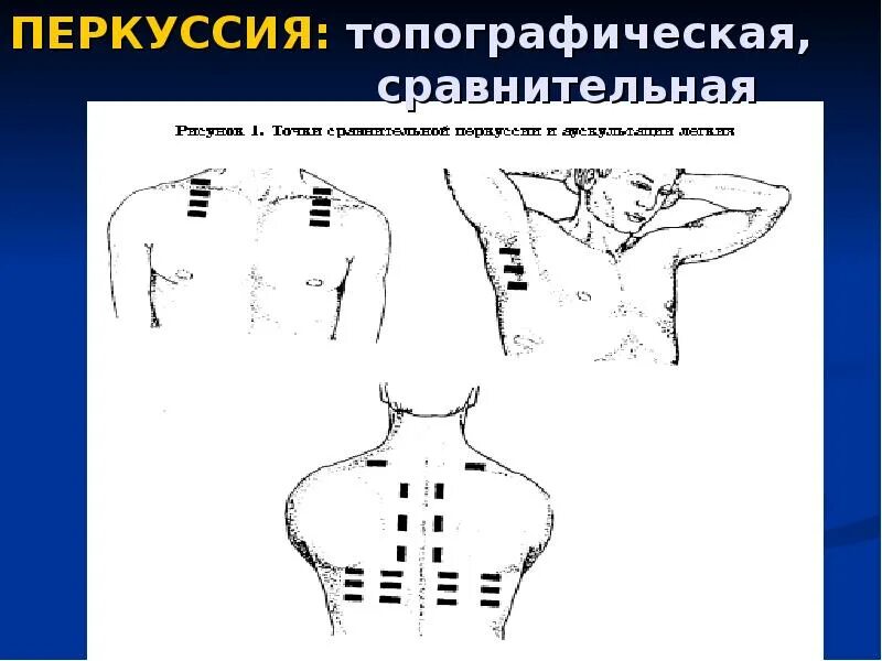 Линии перкуссии грудной клетки. Топографическая перкуссия грудной клетки пропедевтика. Сравнительная перкуссия легких в норме таблица. Топографические границы легких