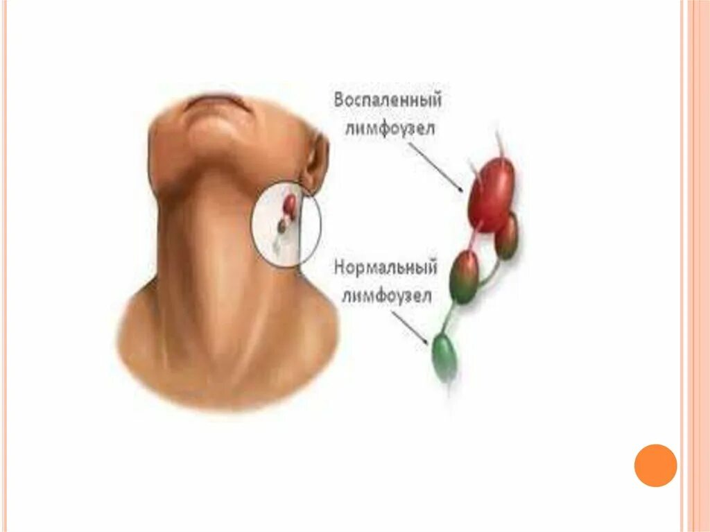 Причина возникновения лимфоузлов. Воспаленные лимфатические узлы. Ушные лимфатические узлы анатомия. Шейные лимфоузлы расположение схема. Строение уха лимфоузлы.
