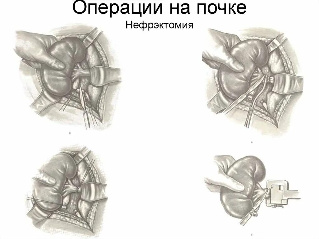 Резекция почки что это. Нефрэктомия ход операции лапароскопическая. Нефрэктомия этапы операции. Операция нефрэктомия топографическая анатомия. Нефрэктомия почки операция.