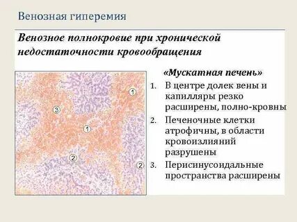 Венозное полнокровие
