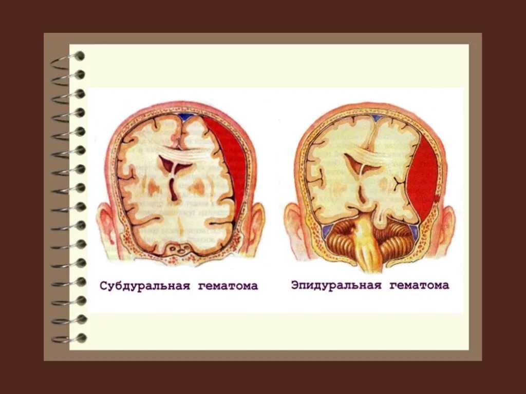 Субдуральная и эпидуральная гематома. Черепно-мозговая травма. Отличия субдуральной и эпидуральной гематомы. Открытая черепно-мозговая травма. Открытая травма мозга