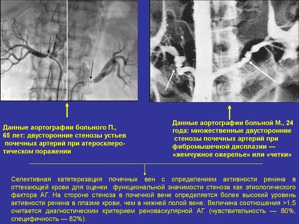 Двустороннем стенозе