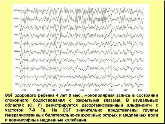 ЭЭГ нормальные показатели у ребенка. ЭЭГ головного мозга ритм Альфа ритм норма. Альфа ритм на ЭЭГ норма. Показатели ЭЭГ норма у ребенка.