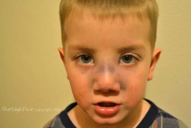 Сильный удар носа. Ушиб переносицы у ребенка. Перелом переносицы у ребенка.
