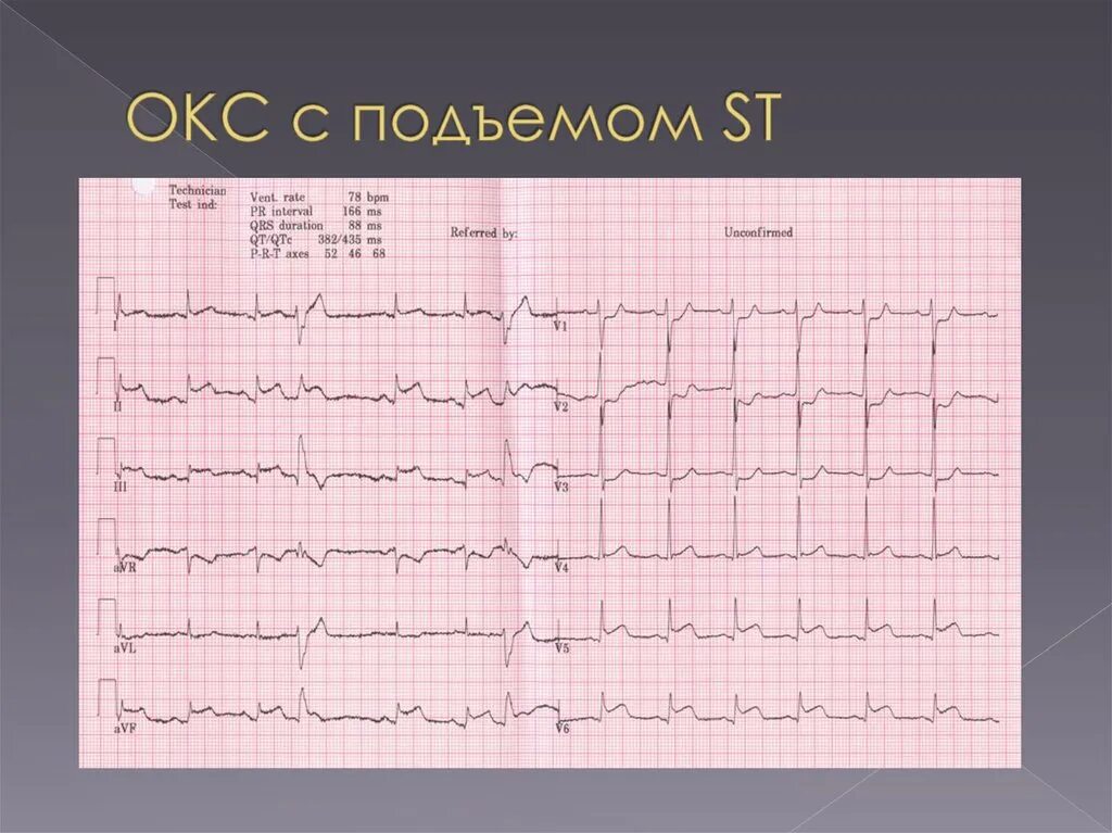 Экг подъем. Окс c подъемом сегмента St ЭКГ. ЭКГ Окс без подъема сегмента St. ЭКГ при инфаркте миокарда без подъема St. ЭКГ инфаркт миокарда с подъемом St.