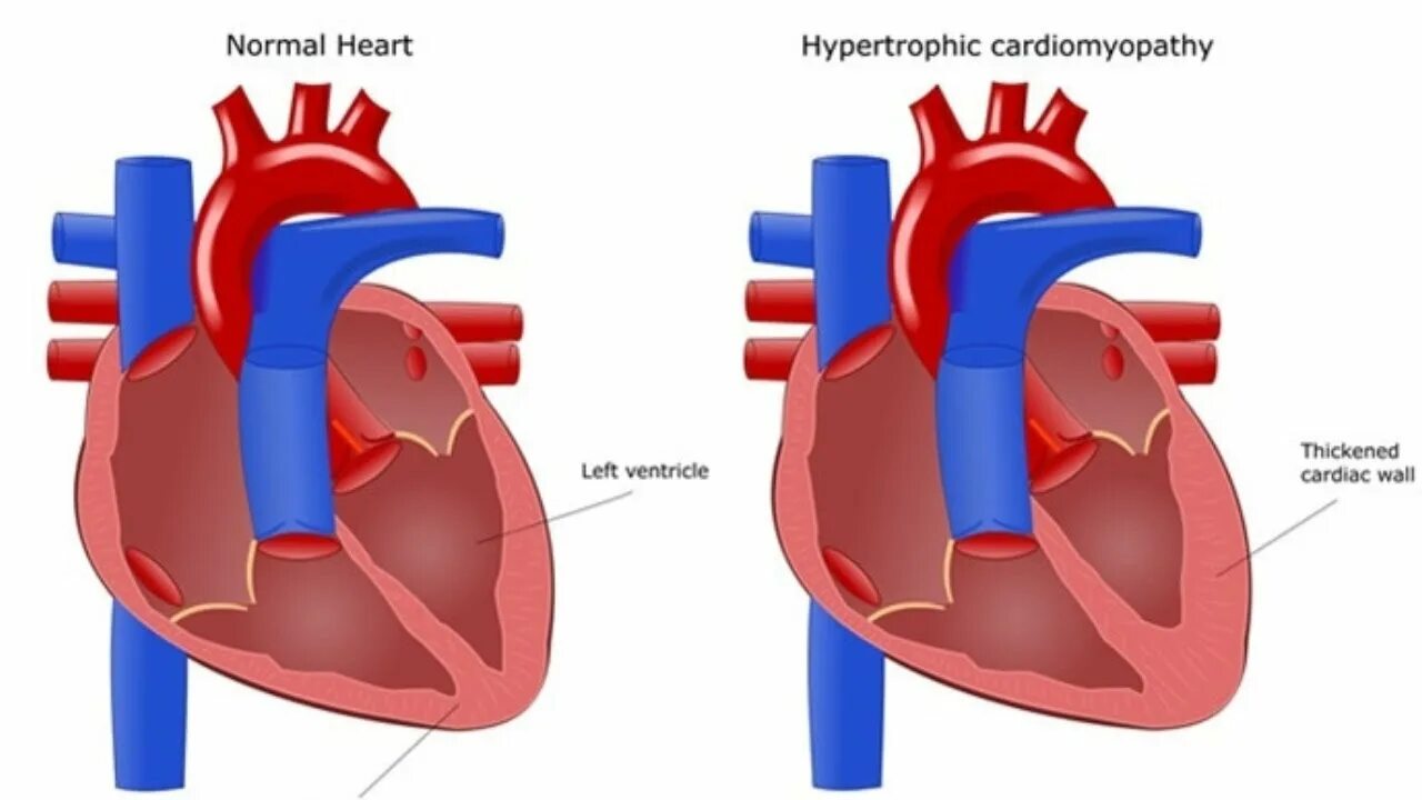 Кардиопатия гипертрофия. Утолщена стенка сердца. Гипертрофическое сердце. Миокард правого желудочка сердца