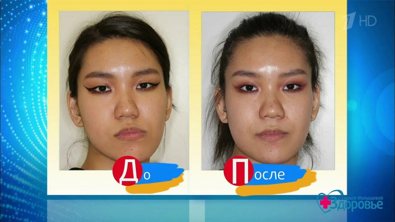 Сегментарная остеотомия челюсти. Ортогнатическая операция краснодар. Пластическая операция на подбородок. Сенюк андрей николаевич. Остеотомия челюсти операция.