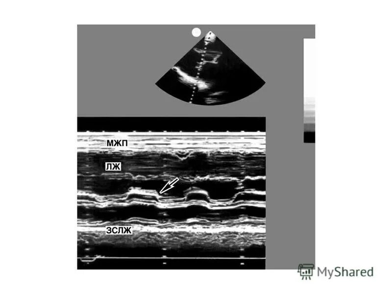 митральная недостаточность доплер эхокардиография. эхокардиография стеноз митрального клапана. стеноз аортального клапана эхокардиография. эхокг митральная регургитация 1 степени. эхокардиография митрального клапана.