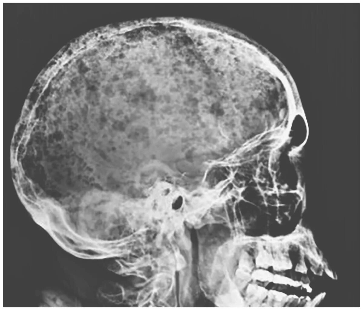 Рентген черепа при миеломной болезни. Множественная миелома рентген черепа. Миеломная болезнь череп. Миеломная болезнь череп. Миеломная болезнь череп.