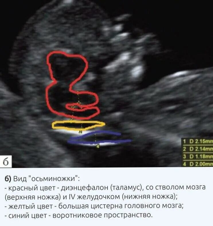 Узи аномалий. Узи маркеры патологии плода.