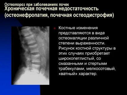Почечная остеодистрофия