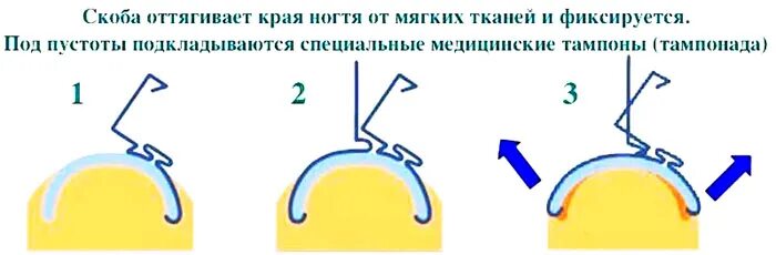 Как устанавливается скоба на ноготь. Постановка скобы на вросший ноготь. Зачем нужные пластины