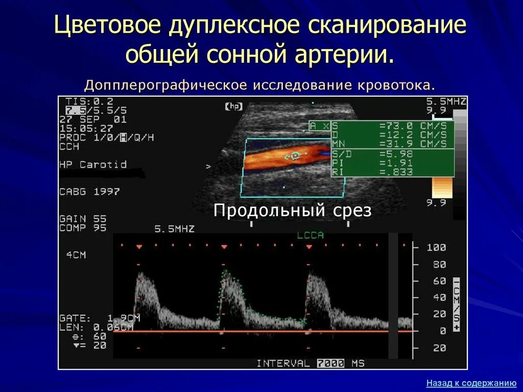 Ультразвуковое дуплексное ангиосканирование. Ультразвуковая допплерография и дуплексное сканирование. Ультразвуковая допплерография сосудов шеи. Ультразвуковое цветовое дуплексное сканирование. Уздс бца что это