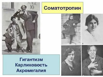 Акромегалия карликовость