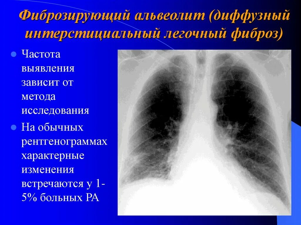 Фиброзирующий альвеолит (синдром Хаммена-Рича).. Синдром Хаммена Рича рентген. Идиопатический фиброзирующий альвеолит рентген. Токсический фиброзирующий альвеолит рентген. Диффузные изменения в легких